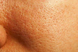 Home-Remedies-to-Get-Rid-of-Clogged-Pores1